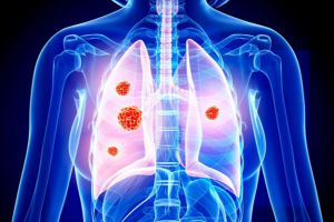 Ung thư phổi giai đoạn 4: Tiên lượng, dấu hiệu nhận biết